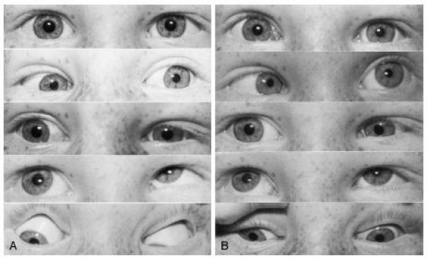 سندرمهای مکانیکال دید دوچشمی (دوئن و براون)