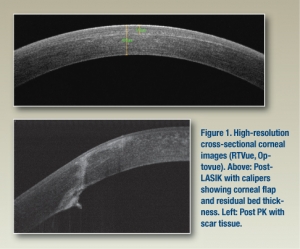 Optometric management of anterior segment